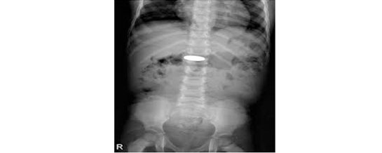 How to Care for Your Child with a Foreign Body Ingestion