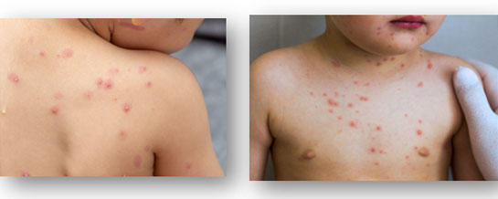 Chicken pox discount in kids