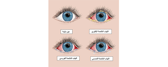 التهاب في المنزل العين علاج طرق علاج