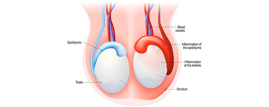 Epididymitis