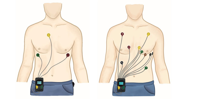 Holter Monitor Electrode Placement ERPM Holter Monitor Electrode Placement ERPM