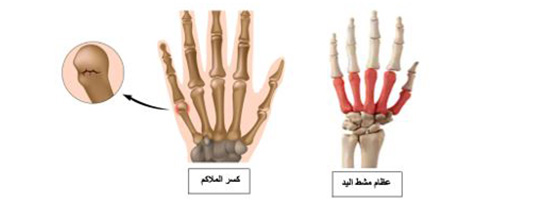 Metacarpal Fracture