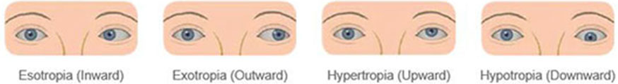 Strabismus