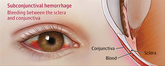 Subconjunctival Hemorrhage