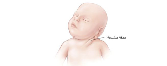 Torticollis