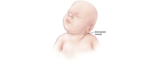 Torticollis