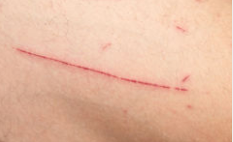 How to Care for Your Child with Laceration (cuts)