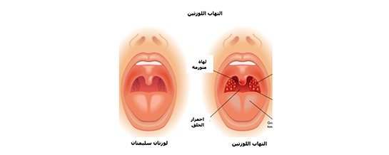 اعراض التهاب الحلق عند الاطفال