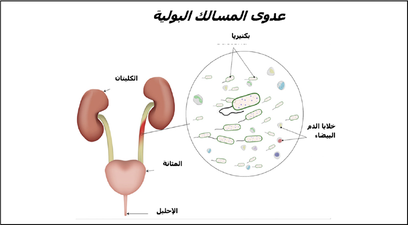 Child with Urinary Tract Infections (UTI)