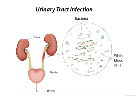 Child with Urinary Tract Infections (UTI)